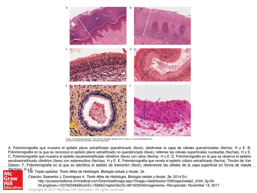 A. Fotomicrografía que muestra el epitelio plano estratificado queratinizado (llave); obsérvese la capa de células queratinizadas (flecha). H y E. B. Fotomicrografía en la que se reconoce el epitelio plano estratificado no queratinizado (llave); nótense las células superficiales nucleadas (flechas). H y E. C. Fotomicrografía que muestra el epitelio seudoestratificado cilíndrico (llave) con cilios (flecha). H y E. D. Fotomicrografía en la que se observa el epitelio seudoestratificado cilíndrico (llave) con estereocilios (flechas). H y E. E. Fotomicrografía que revela el epitelio cúbico estratificado (flecha). Tinción de Van Gieson. F. Fotomicrografía en la que se identifica el epitelio de transición (llave); obsérvense las células de la capa superficial en forma de cúpula (flechas). H y E.