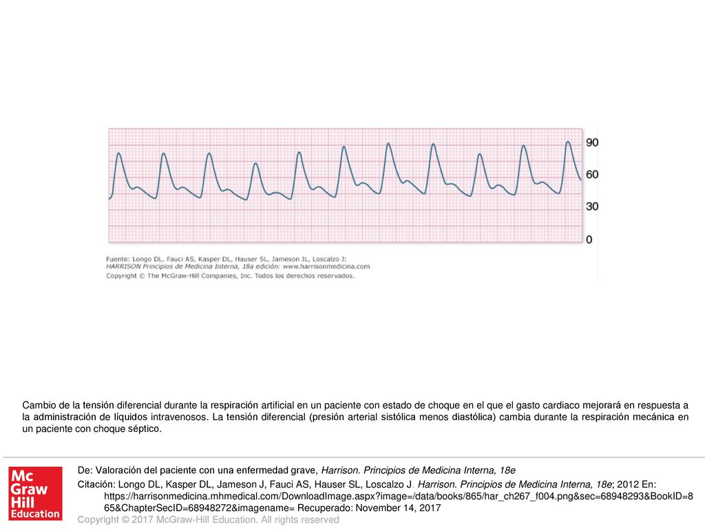 Cambio de la tensión diferencial durante la respiración artificial en un paciente con estado de choque en el que el gasto cardiaco mejorará en respuesta a la administración de líquidos intravenosos. La tensión diferencial (presión arterial sistólica menos diastólica) cambia durante la respiración mecánica en un paciente con choque séptico.