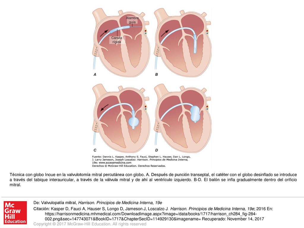 Técnica con globo Inoue en la valvulotomía mitral percutánea con globo