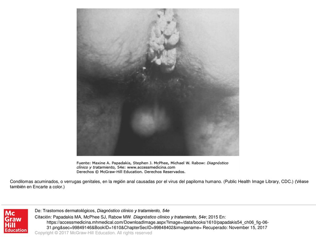 Condilomas acuminados, o verrugas genitales, en la región anal causadas por el virus del papiloma humano. (Public Health Image Library, CDC.) (Véase también en Encarte a color.)