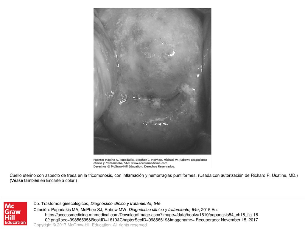 Cuello uterino con aspecto de fresa en la tricomonosis, con inflamación y hemorragias puntiformes. (Usada con autorización de Richard P. Usatine, MD.) (Véase también en Encarte a color.)
