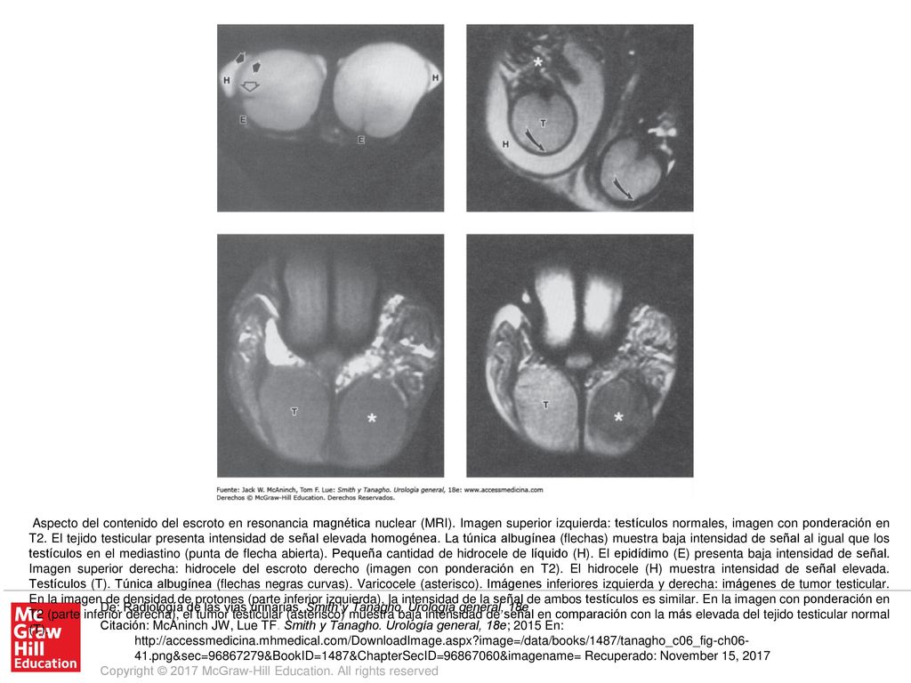 Aspecto del contenido del escroto en resonancia magnética nuclear (MRI). Imagen superior izquierda: testículos normales, imagen con ponderación en T2. El tejido testicular presenta intensidad de señal elevada homogénea. La túnica albugínea (flechas) muestra baja intensidad de señal al igual que los testículos en el mediastino (punta de flecha abierta). Pequeña cantidad de hidrocele de líquido (H). El epidídimo (E) presenta baja intensidad de señal. Imagen superior derecha: hidrocele del escroto derecho (imagen con ponderación en T2). El hidrocele (H) muestra intensidad de señal elevada. Testículos (T). Túnica albugínea (flechas negras curvas). Varicocele (asterisco). Imágenes inferiores izquierda y derecha: imágenes de tumor testicular. En la imagen de densidad de protones (parte inferior izquierda), la intensidad de la señal de ambos testículos es similar. En la imagen con ponderación en T2 (parte inferior derecha), el tumor testicular (asterisco) muestra baja intensidad de señal en comparación con la más elevada del tejido testicular normal (T).