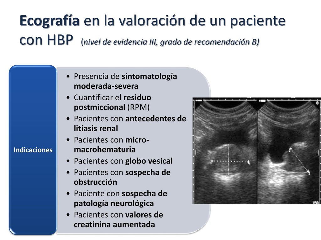 Ecografía en la valoración de un paciente con HBP (nivel de evidencia III, grado de recomendación B)