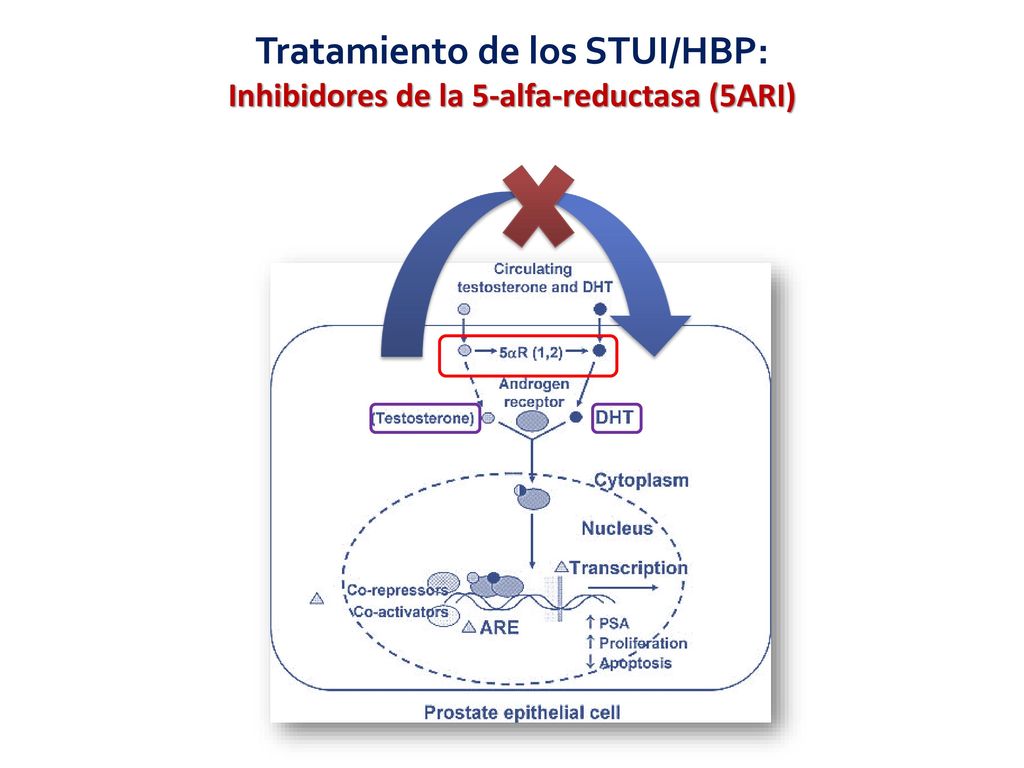 Tratamiento de los STUI/HBP: Inhibidores de la 5-alfa-reductasa (5ARI)