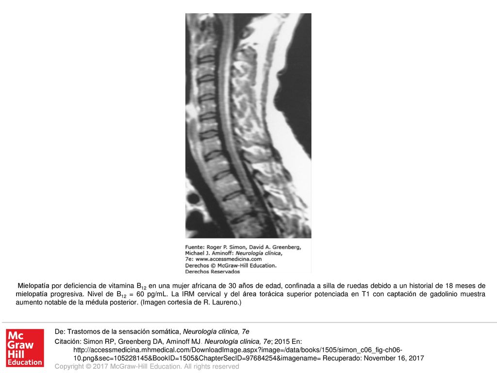 Mielopatía por deficiencia de vitamina B12 en una mujer africana de 30 años de edad, confinada a silla de ruedas debido a un historial de 18 meses de mielopatía progresiva. Nivel de B12 = 60 pg/mL. La IRM cervical y del área torácica superior potenciada en T1 con captación de gadolinio muestra aumento notable de la médula posterior. (Imagen cortesía de R. Laureno.)