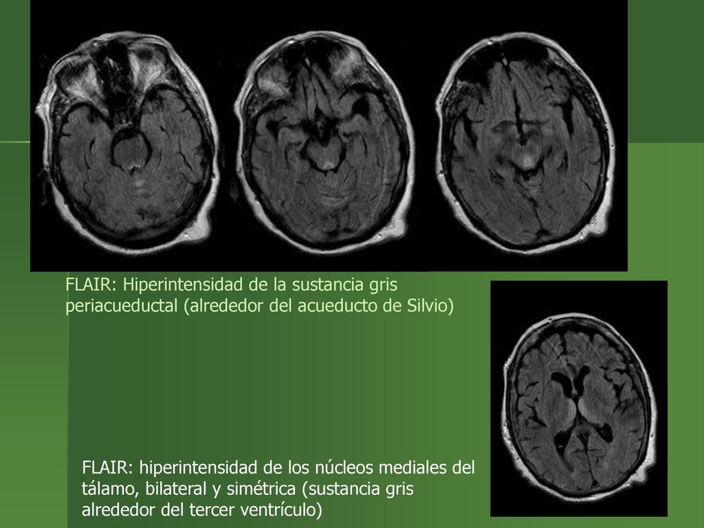 FLAIR: Hiperintensidad de la sustancia gris periacueductal (alrededor del acueducto de Silvio)