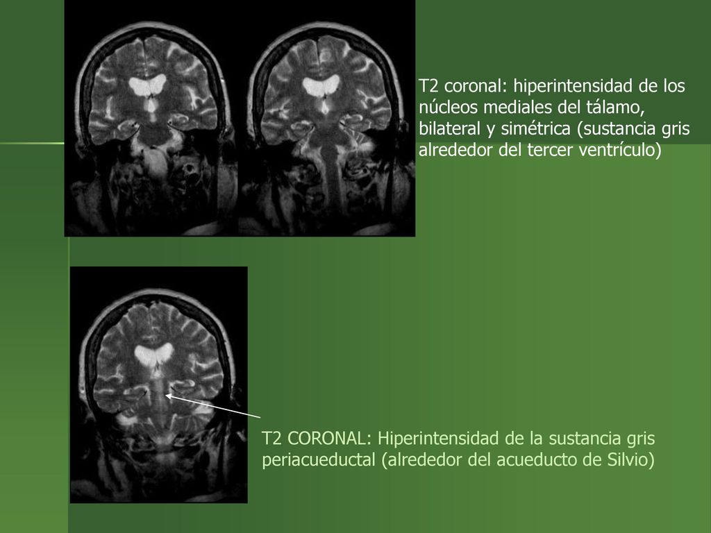 T2 coronal: hiperintensidad de los núcleos mediales del tálamo, bilateral y simétrica (sustancia gris alrededor del tercer ventrículo)