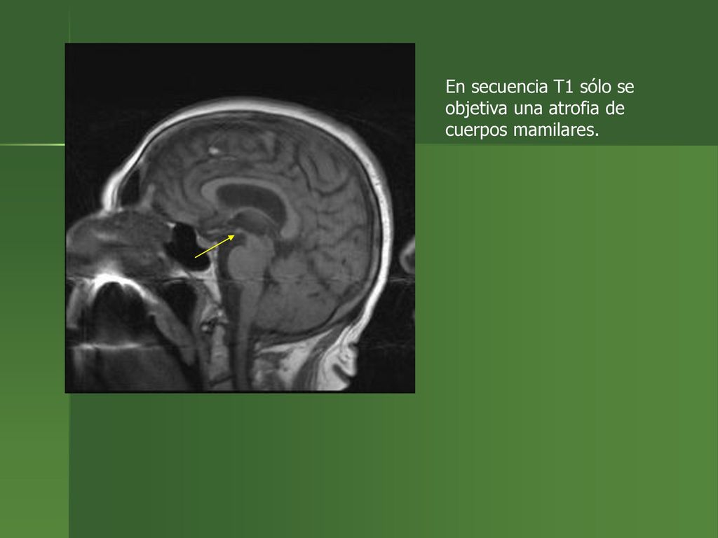 En secuencia T1 sólo se objetiva una atrofia de cuerpos mamilares.