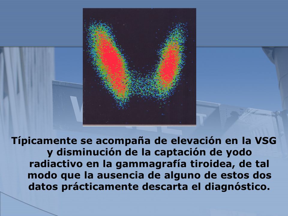 Típicamente se acompaña de elevación en la VSG y disminución de la captación de yodo radiactivo en la gammagrafía tiroidea, de tal modo que la ausencia de alguno de estos dos datos prácticamente descarta el diagnóstico.