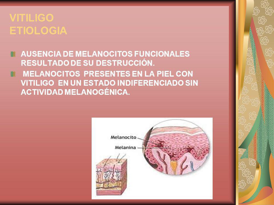 VITILIGO ETIOLOGIA AUSENCIA DE MELANOCITOS FUNCIONALES RESULTADO DE SU DESTRUCCIÓN.