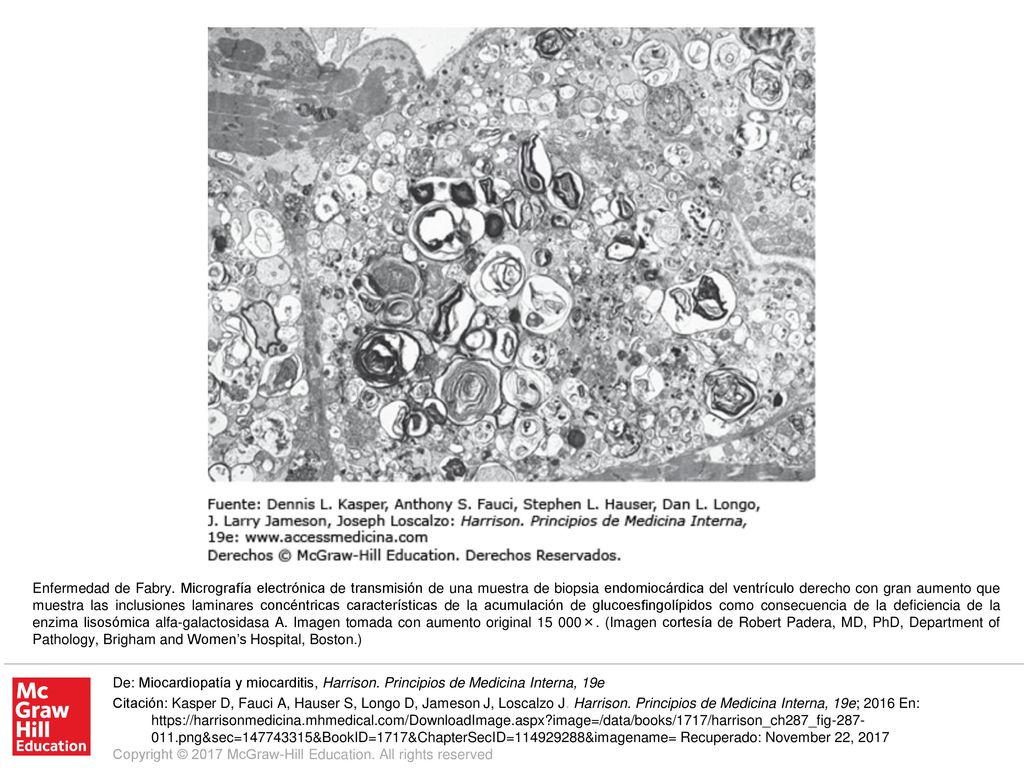 Enfermedad de Fabry. Micrografía electrónica de transmisión de una muestra de biopsia endomiocárdica del ventrículo derecho con gran aumento que muestra las inclusiones laminares concéntricas características de la acumulación de glucoesfingolípidos como consecuencia de la deficiencia de la enzima lisosómica alfa-galactosidasa A. Imagen tomada con aumento original ×. (Imagen cortesía de Robert Padera, MD, PhD, Department of Pathology, Brigham and Women’s Hospital, Boston.)
