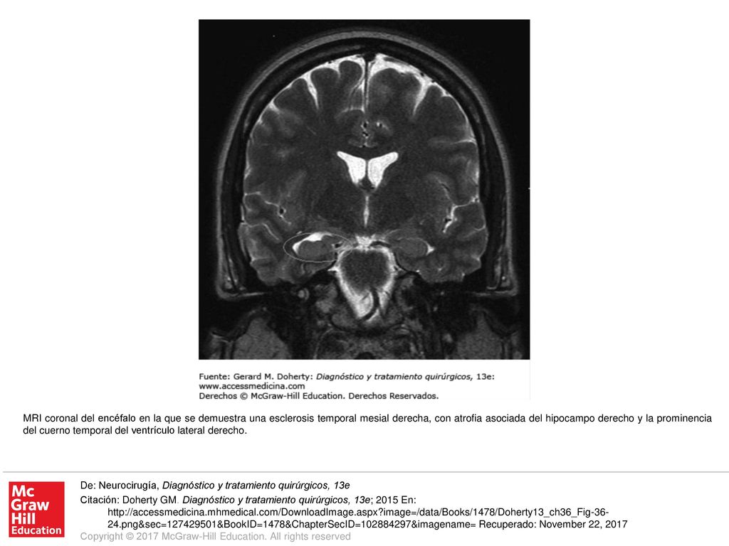MRI coronal del encéfalo en la que se demuestra una esclerosis temporal mesial derecha, con atrofia asociada del hipocampo derecho y la prominencia del cuerno temporal del ventrículo lateral derecho.