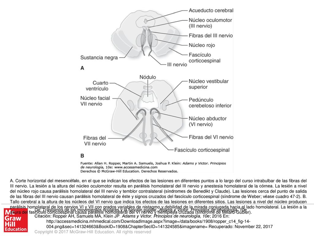 A. Corte horizontal del mesencéfalo, en el que se indican los efectos de las lesiones en diferentes puntos a lo largo del curso intrabulbar de las fibras del III nervio. La lesión a la altura del núcleo oculomotor resulta en parálisis homolateral del III nervio y anestesia homolateral de la córnea. La lesión a nivel del núcleo rojo causa parálisis homolateral del III nervio y temblor contralateral (síndromes de Benedikt y Claude). Las lesiones cerca del punto de salida de las fibras del III nervio causan parálisis homolateral de éste y signos cruzados del fascículo corticoespinal (síndrome de Weber; véase cuadro 47-2). B. Tallo cerebral a la altura de los núcleos del VI nervio que indica los efectos de las lesiones en diferentes sitios. Las lesiones a nivel del núcleo producen parálisis homolateral de los nervios VI y VII con grados variables de nistagmo y debilidad de la mirada conjugada hacia el lado homolateral. La lesión a la altura del fascículo corticoespinal causa parálisis homolateral del VI nervio y hemiplejía cruzada (síndrome de Millard-Gubler).