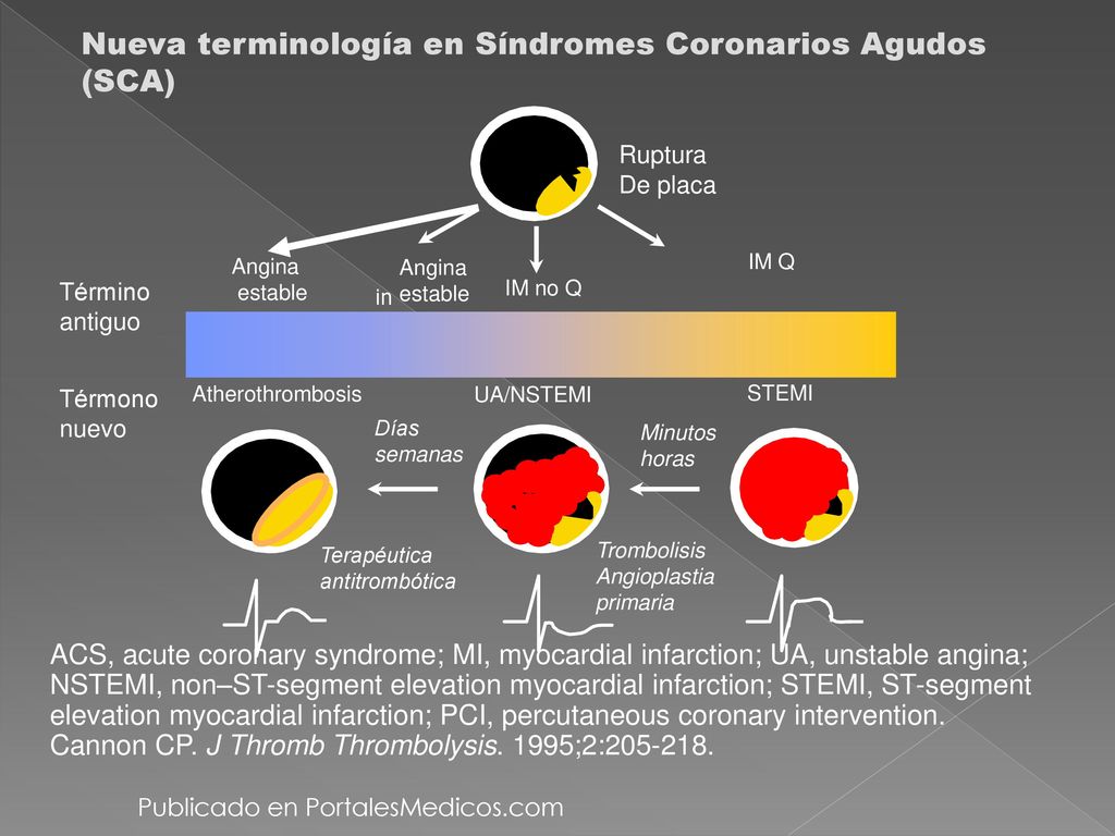 Nueva terminología en Síndromes Coronarios Agudos (SCA)