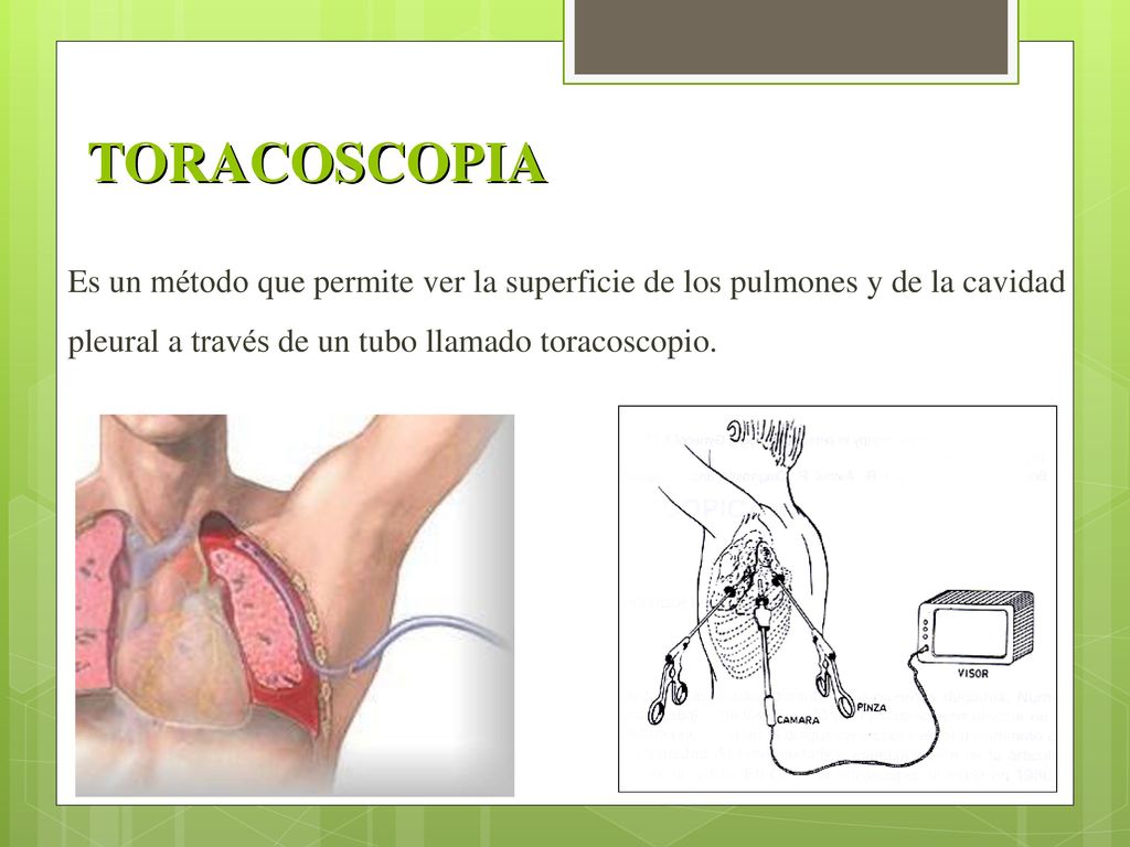 TORACOSCOPIA Es un método que permite ver la superficie de los pulmones y de la cavidad pleural a través de un tubo llamado toracoscopio.