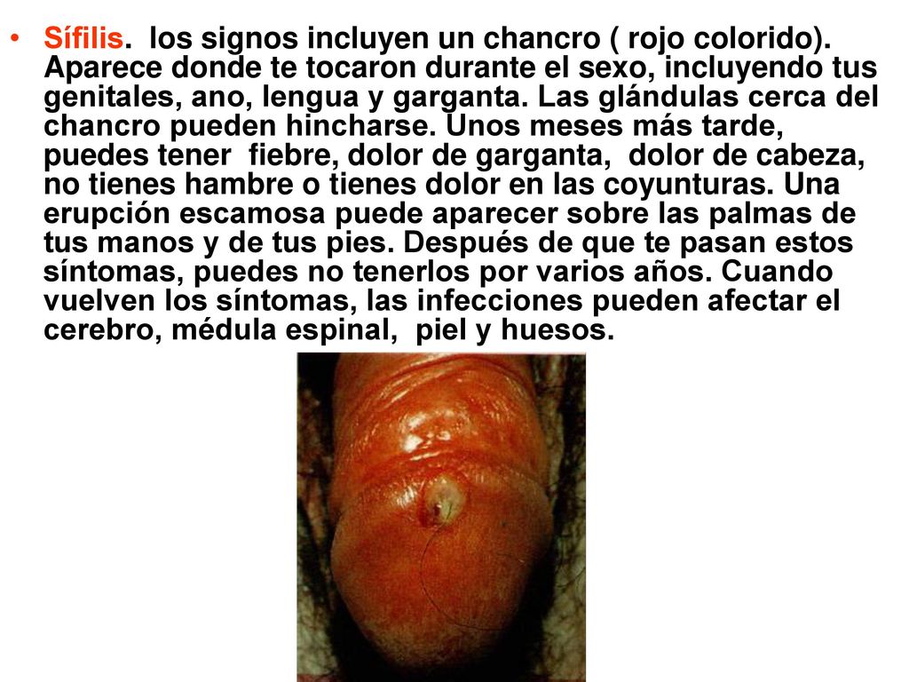 Sífilis. los signos incluyen un chancro ( rojo colorido)