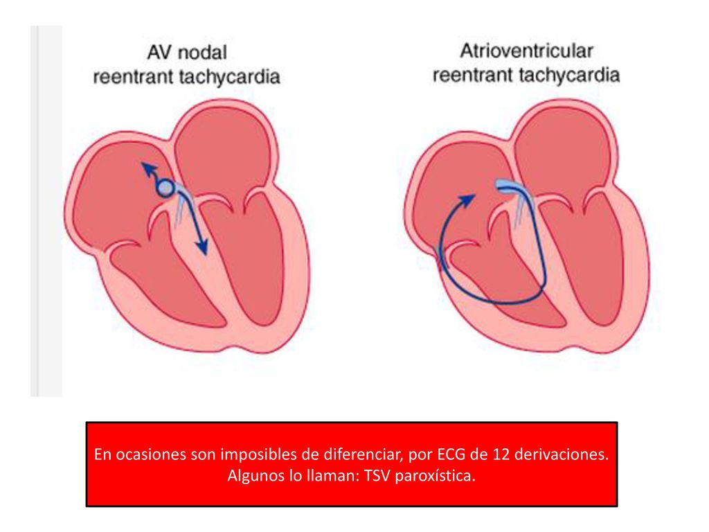 En ocasiones son imposibles de diferenciar, por ECG de 12 derivaciones