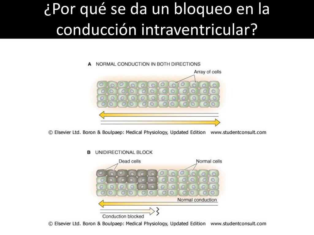 ¿Por qué se da un bloqueo en la conducción intraventricular