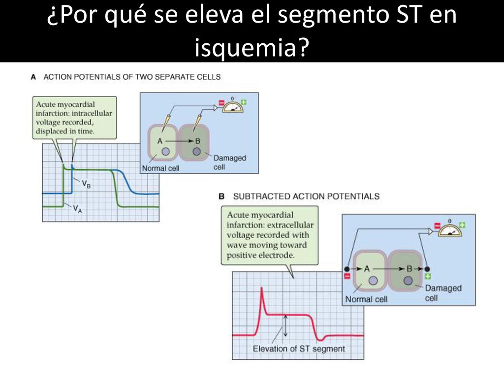 ¿Por qué se eleva el segmento ST en isquemia