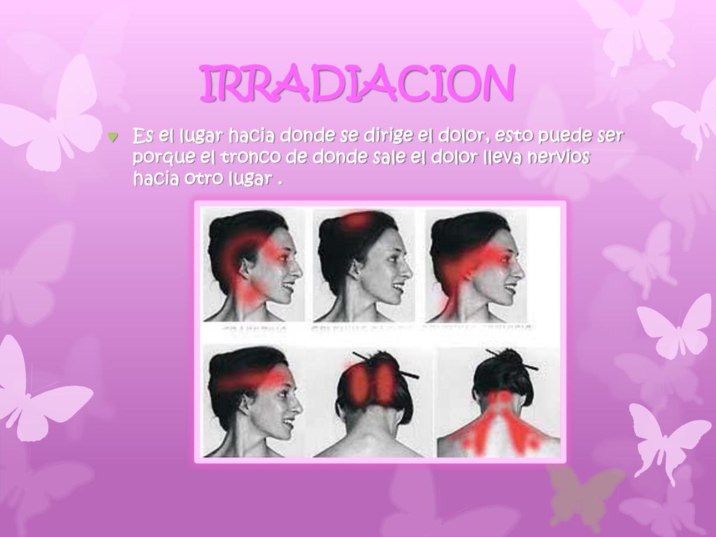 IRRADIACION Es el lugar hacia donde se dirige el dolor, esto puede ser porque el tronco de donde sale el dolor lleva nervios hacia otro lugar .