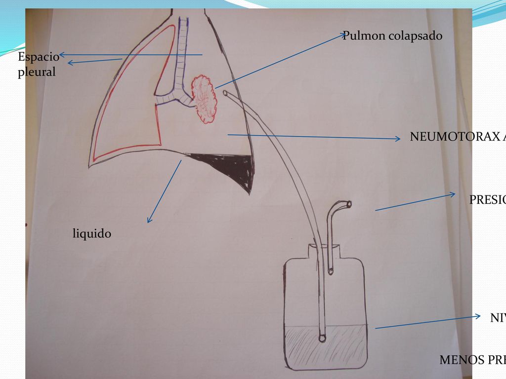 Pulmon colapsado Espacio pleural NEUMOTORAX AIRE PRESION ATM liquido NIVEL LIQUIDO MENOS PRESION