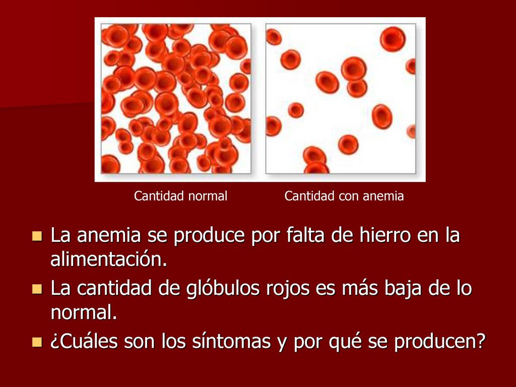 La anemia se produce por falta de hierro en la alimentación.