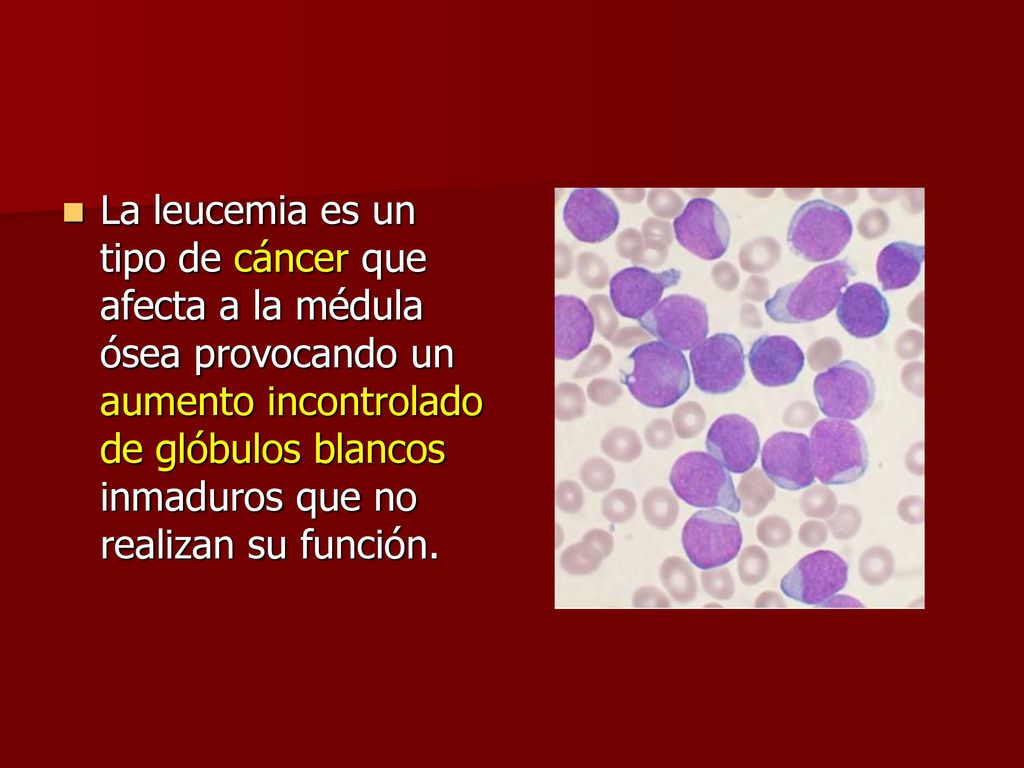 La leucemia es un tipo de cáncer que afecta a la médula ósea provocando un aumento incontrolado de glóbulos blancos inmaduros que no realizan su función.