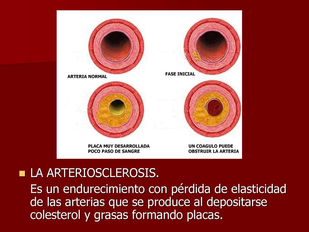 FASE INICIAL ARTERIA NORMAL. PLACA MUY DESARROLLADA. POCO PASO DE SANGRE. UN COAGULO PUEDE. OBSTRUIR LA ARTERIA.