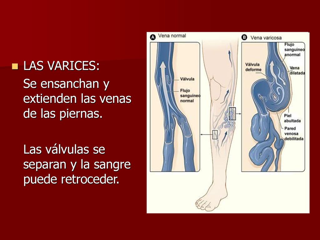 LAS VARICES: Se ensanchan y extienden las venas de las piernas.