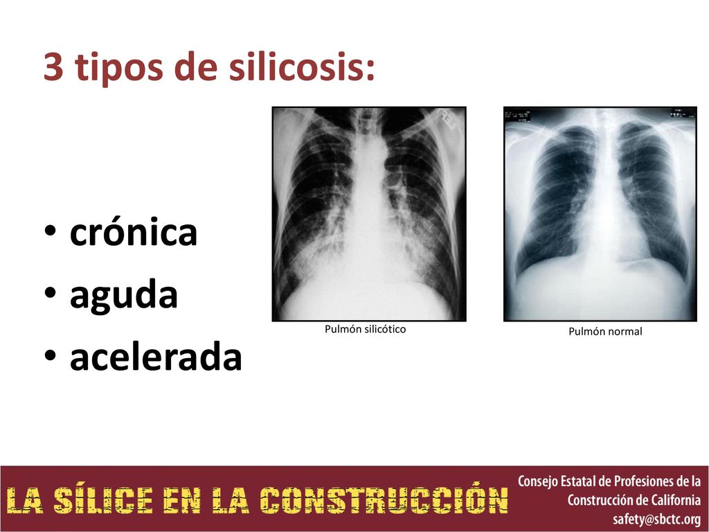3 tipos de silicosis: crónica aguda acelerada Pulmón silicótico