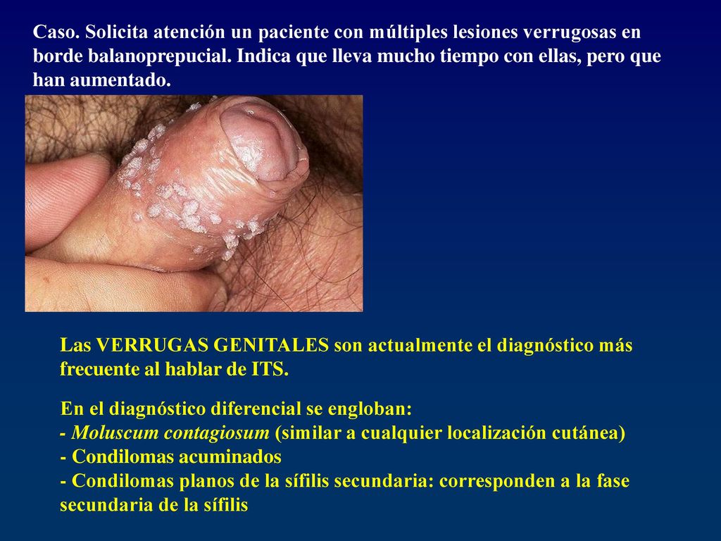 Caso. Solicita atención un paciente con múltiples lesiones verrugosas en borde balanoprepucial. Indica que lleva mucho tiempo con ellas, pero que han aumentado.