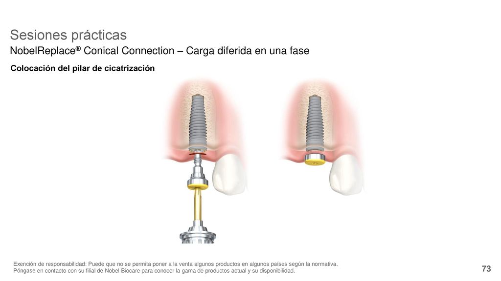 Sesiones prácticas NobelReplace® Conical Connection – Carga diferida en una fase. Colocación del pilar de cicatrización.