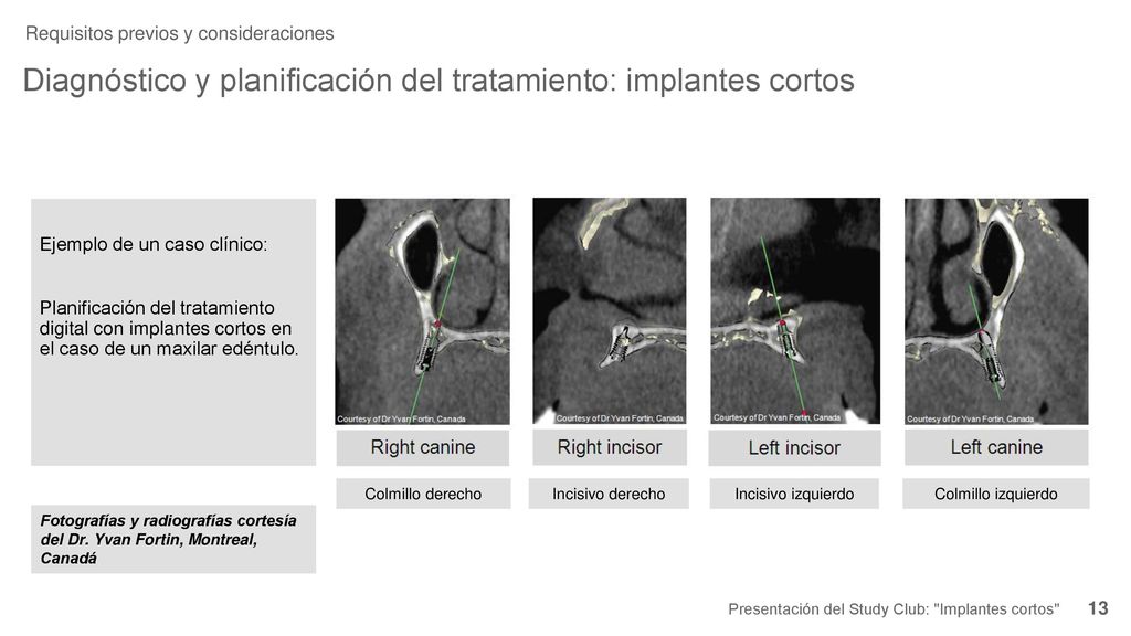 Diagnóstico y planificación del tratamiento: implantes cortos