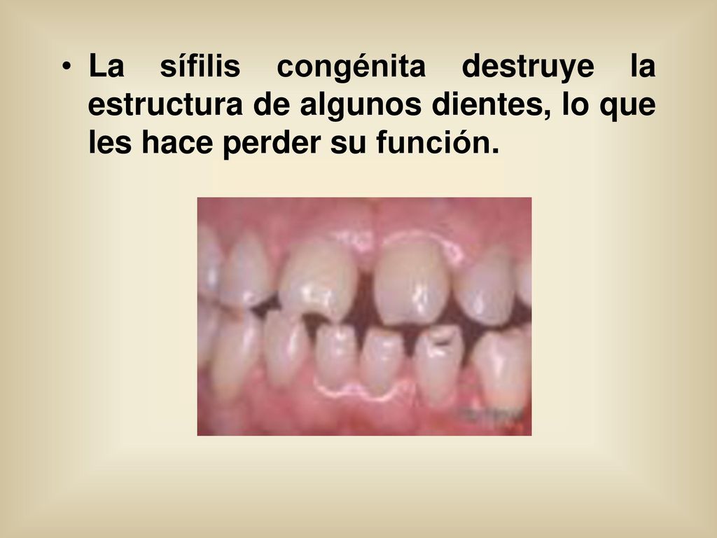 La sífilis congénita destruye la estructura de algunos dientes, lo que les hace perder su función.