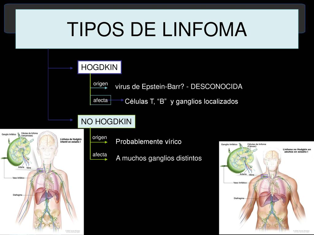 TIPOS DE LINFOMA HOGDKIN NO HOGDKIN