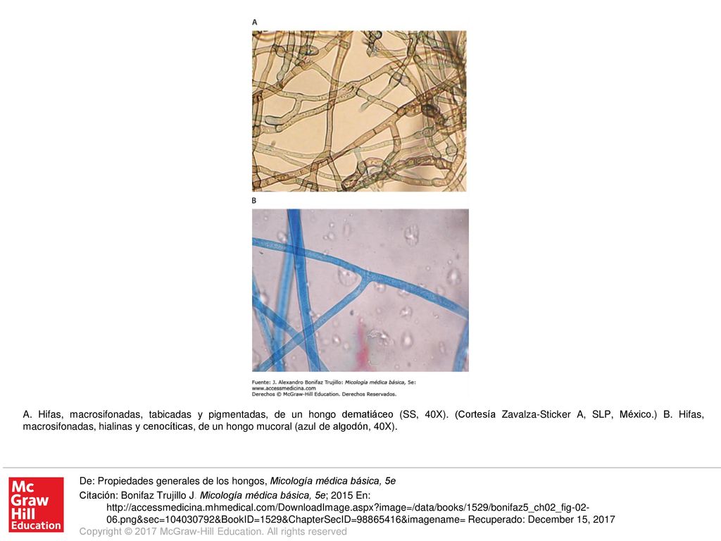 A. Hifas, macrosifonadas, tabicadas y pigmentadas, de un hongo dematiáceo (SS, 40X). (Cortesía Zavalza-Sticker A, SLP, México.) B. Hifas, macrosifonadas, hialinas y cenocíticas, de un hongo mucoral (azul de algodón, 40X).