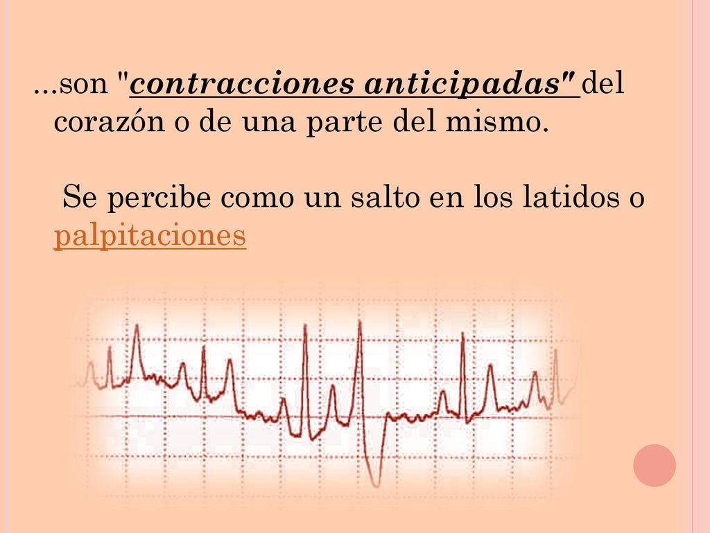 son contracciones anticipadas del corazón o de una parte del mismo
