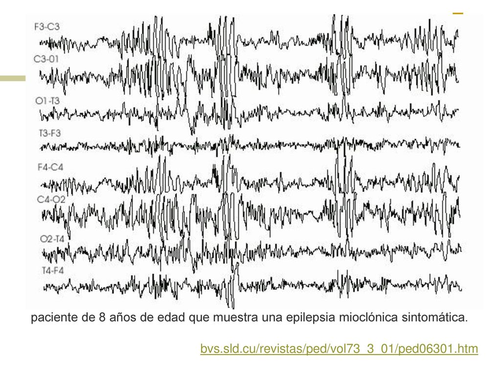 paciente de 8 años de edad que muestra una epilepsia mioclónica sintomática.