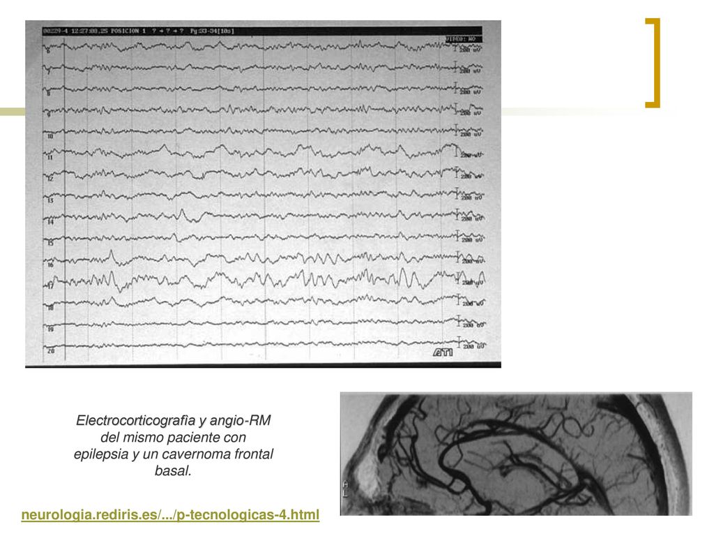 Electrocorticografìa y angio-RM del mismo paciente con epilepsia y un cavernoma frontal basal.