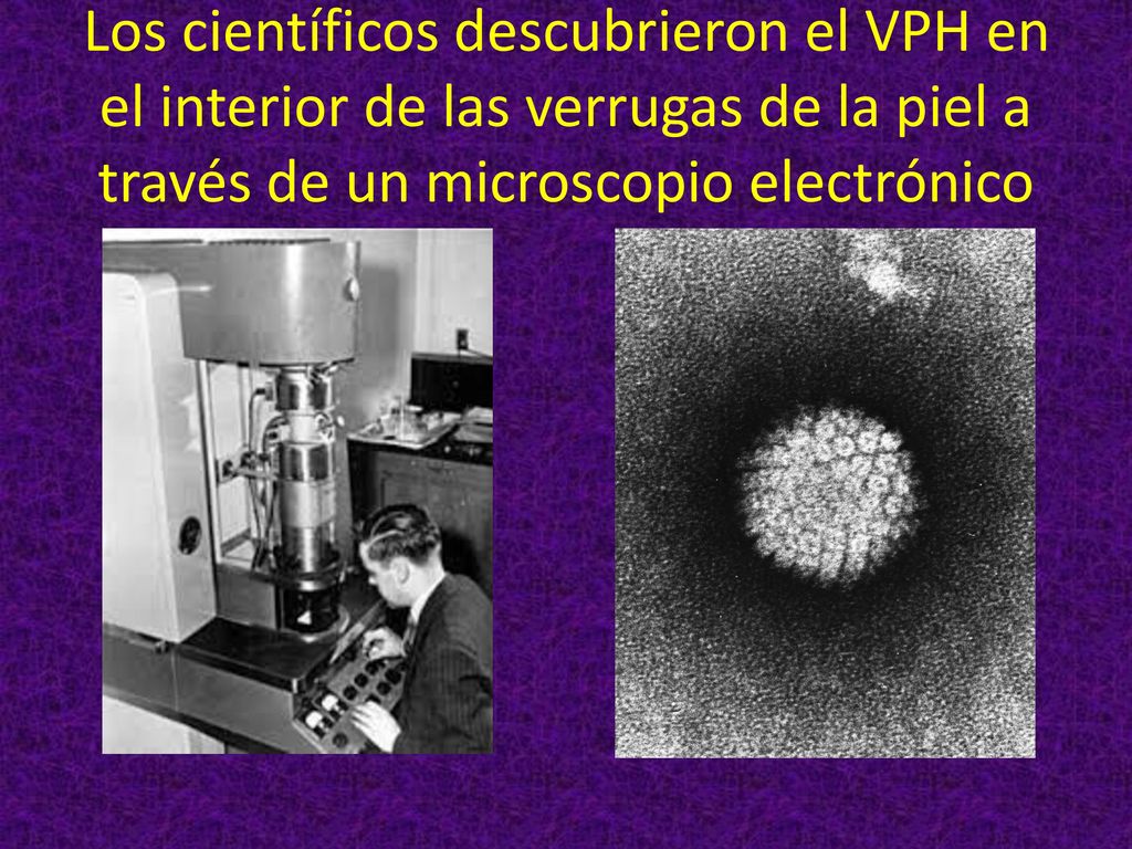 Los científicos descubrieron el VPH en el interior de las verrugas de la piel a través de un microscopio electrónico