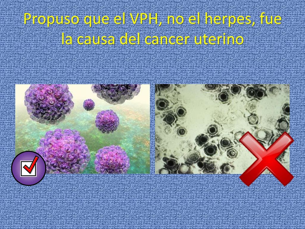 Propuso que el VPH, no el herpes, fue la causa del cancer uterino