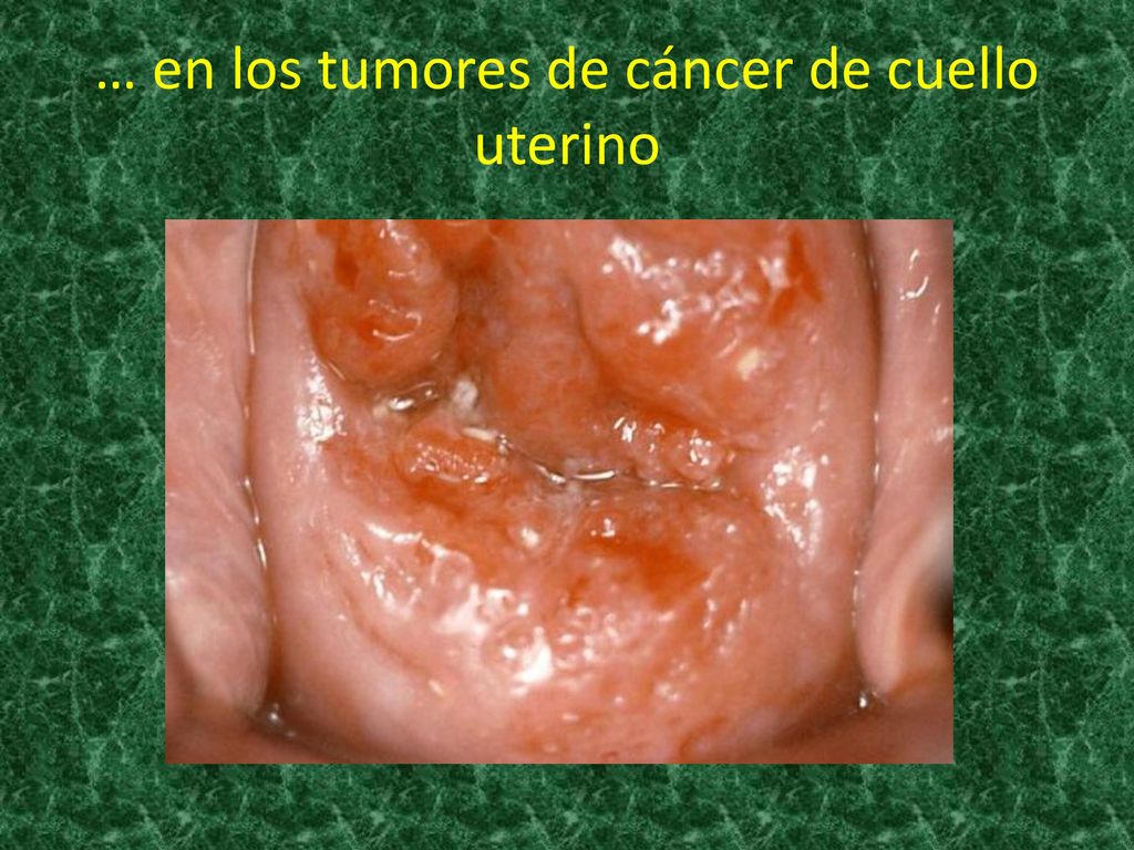… en los tumores de cáncer de cuello uterino