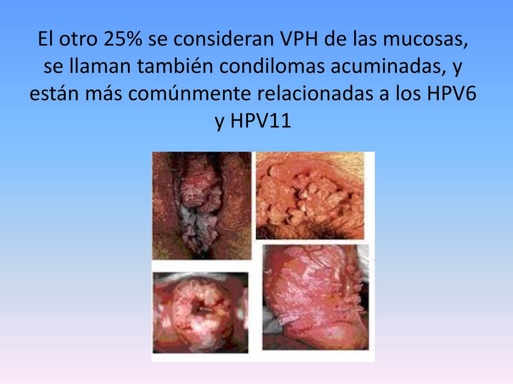El otro 25% se consideran VPH de las mucosas, se llaman también condilomas acuminadas, y están más comúnmente relacionadas a los HPV6 y HPV11