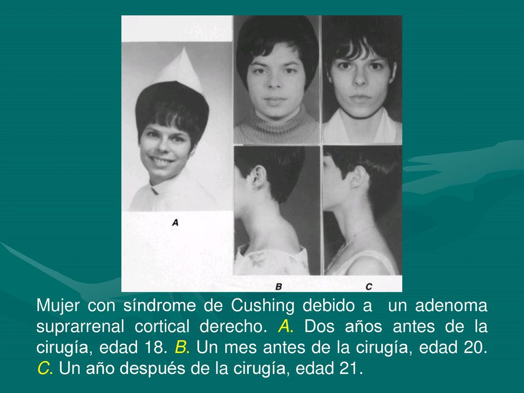Mujer con síndrome de Cushing debido a un adenoma suprarrenal cortical derecho.