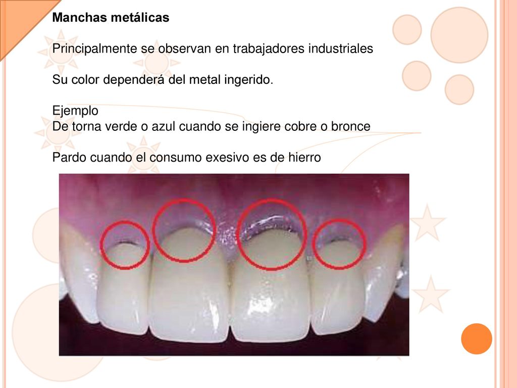 Manchas metálicas Principalmente se observan en trabajadores industriales. Su color dependerá del metal ingerido.