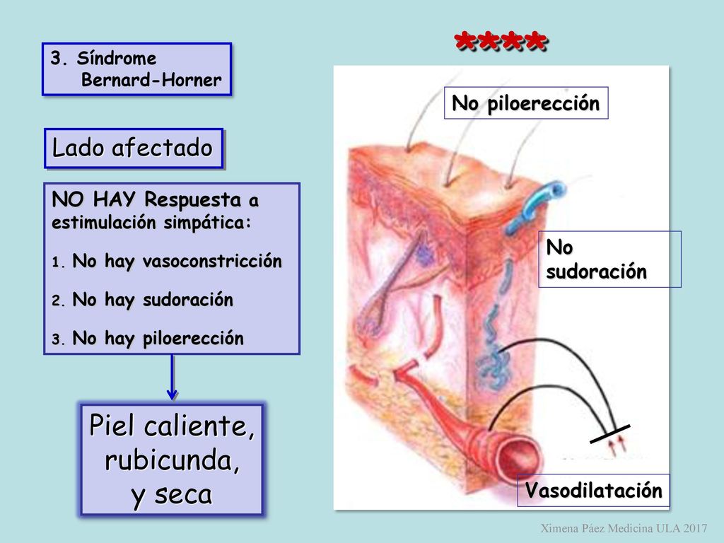 **** Piel caliente, rubicunda, y seca Lado afectado No piloerección
