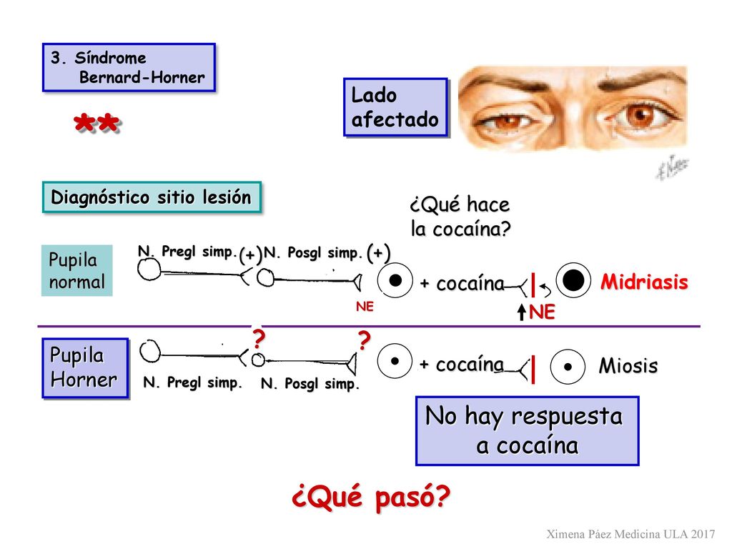** ¿Qué pasó No hay respuesta a cocaína Lado afectado ¿Qué hace