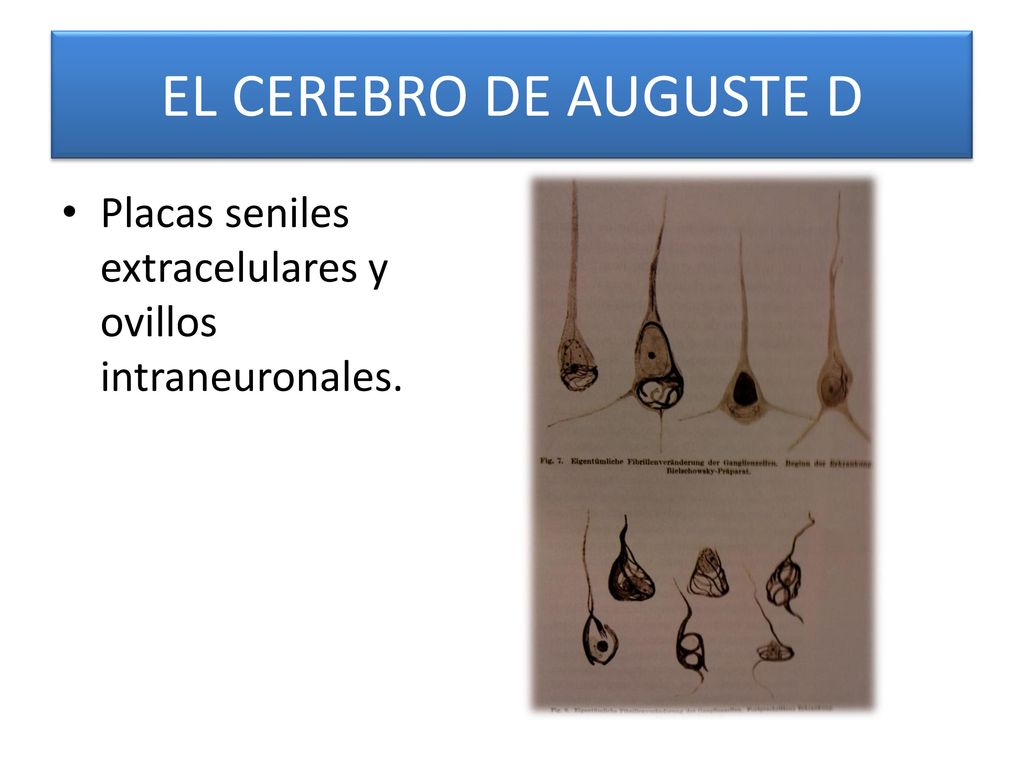 EL CEREBRO DE AUGUSTE D Placas seniles extracelulares y ovillos intraneuronales.
