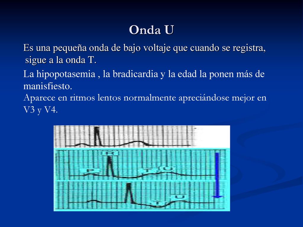 Onda U Es una pequeña onda de bajo voltaje que cuando se registra, sigue a la onda T.