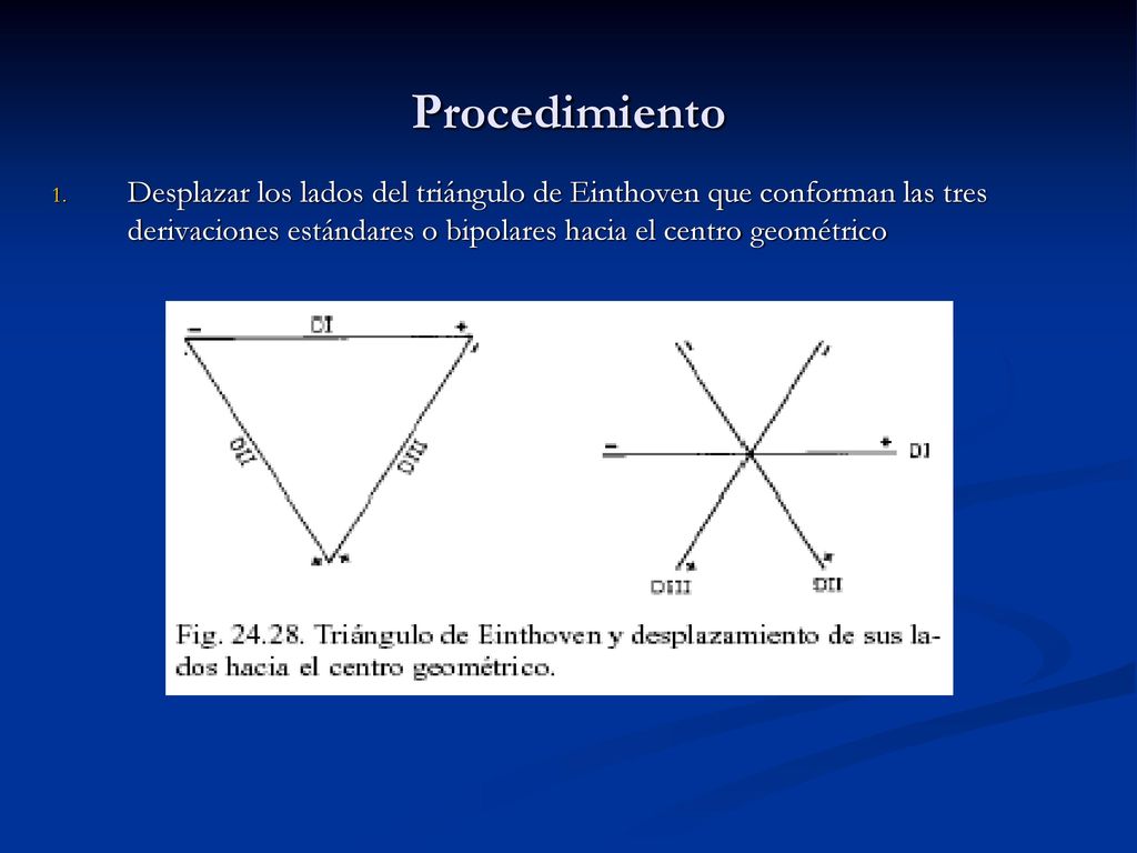 Procedimiento Desplazar los lados del triángulo de Einthoven que conforman las tres derivaciones estándares o bipolares hacia el centro geométrico.